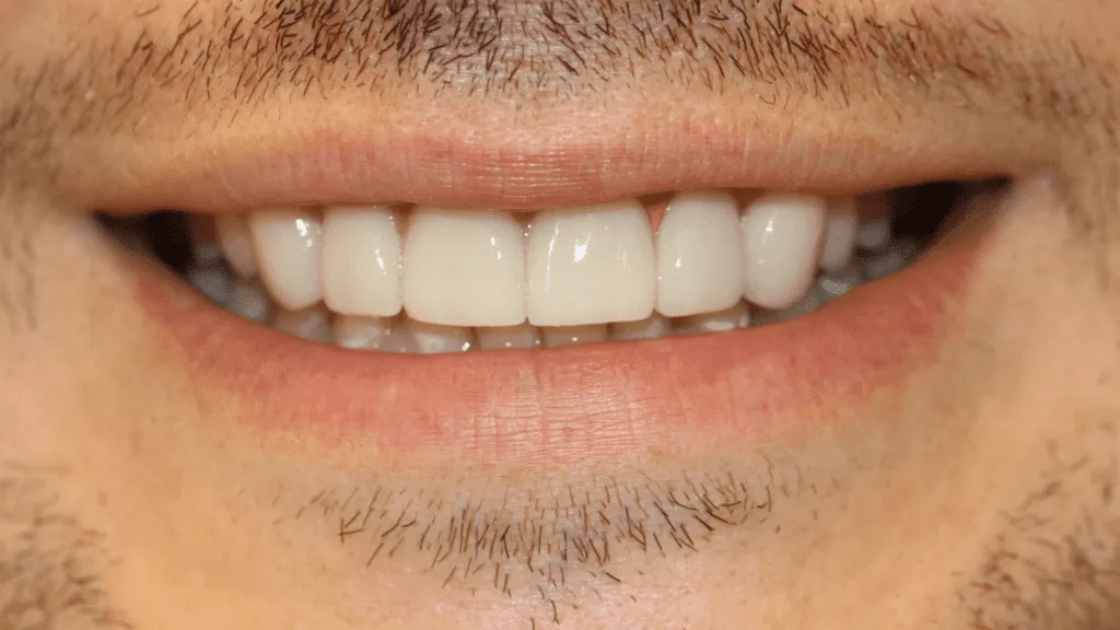 Reabilitare estetică frontală cu fațete ceramice, după tratament